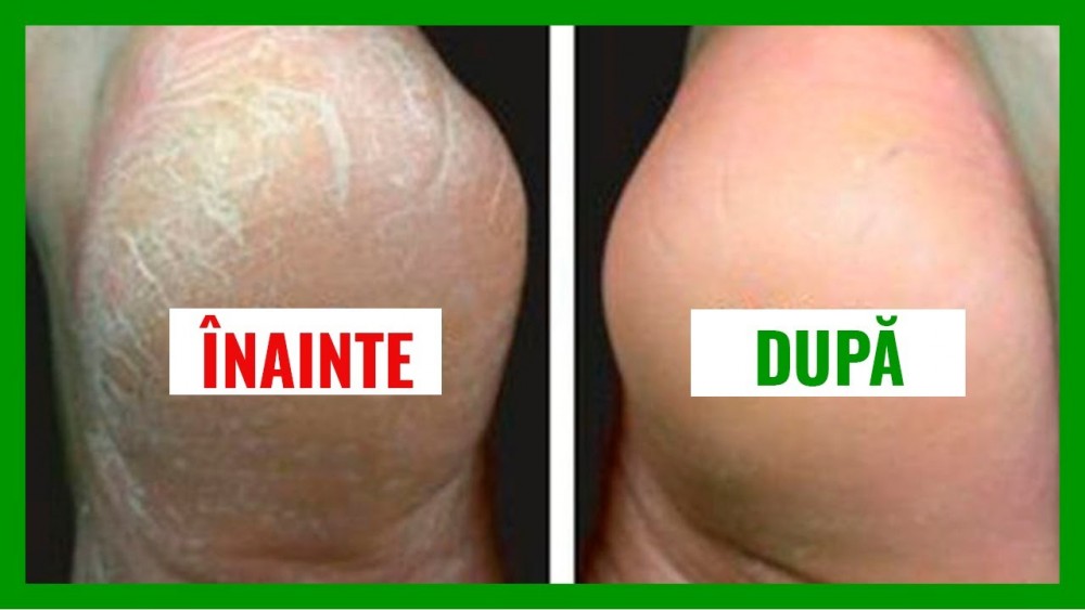 Cum să-ți îngrijești călcâiele uscate și crăpate. 4 remedii pe care le poți încerca acasă